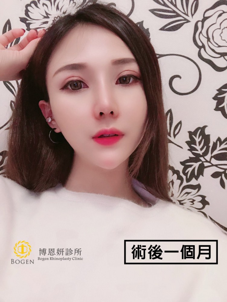雙眼皮重修與提眼瞼肌矯正手術,提眼瞼肌矯正,博恩妍